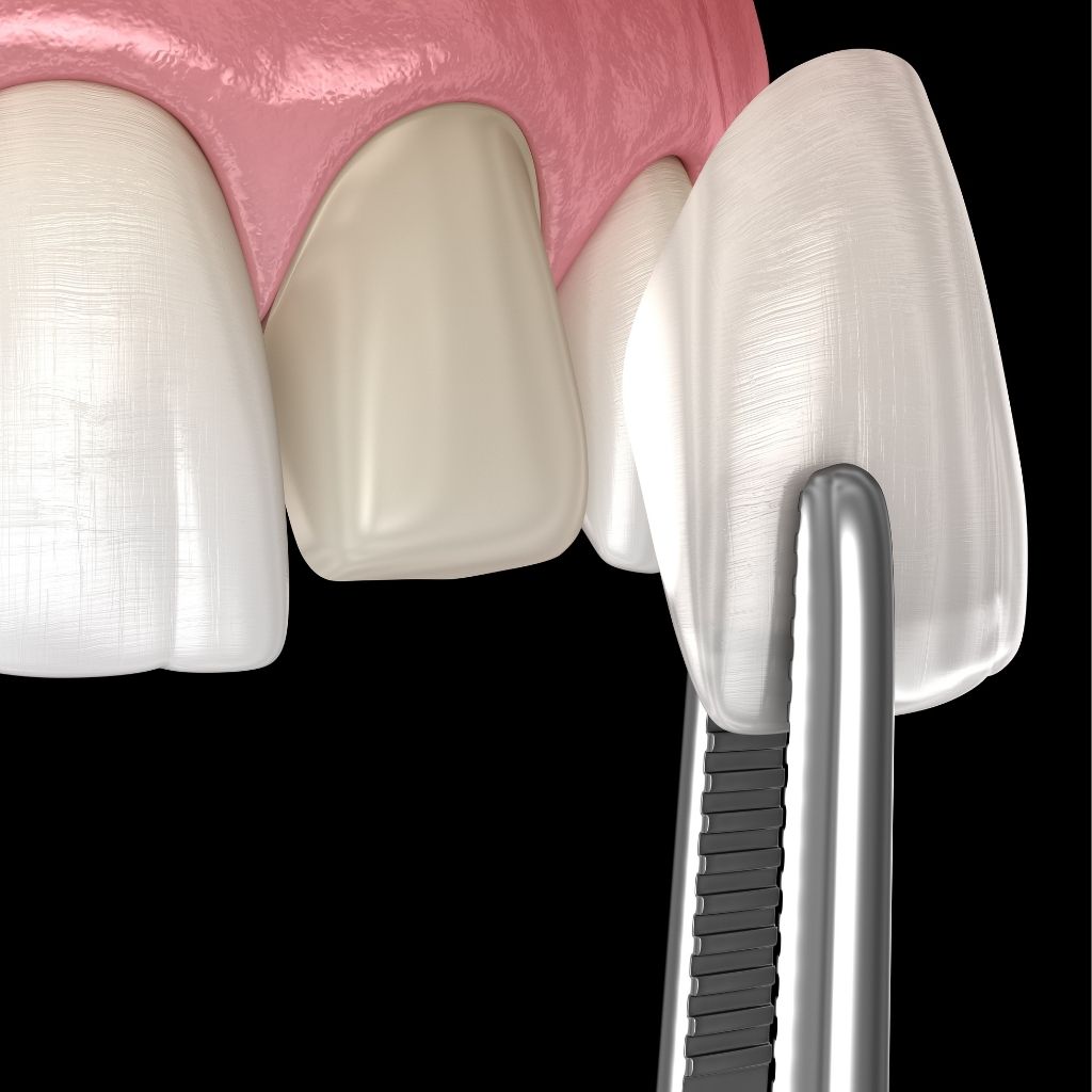 dental veneers