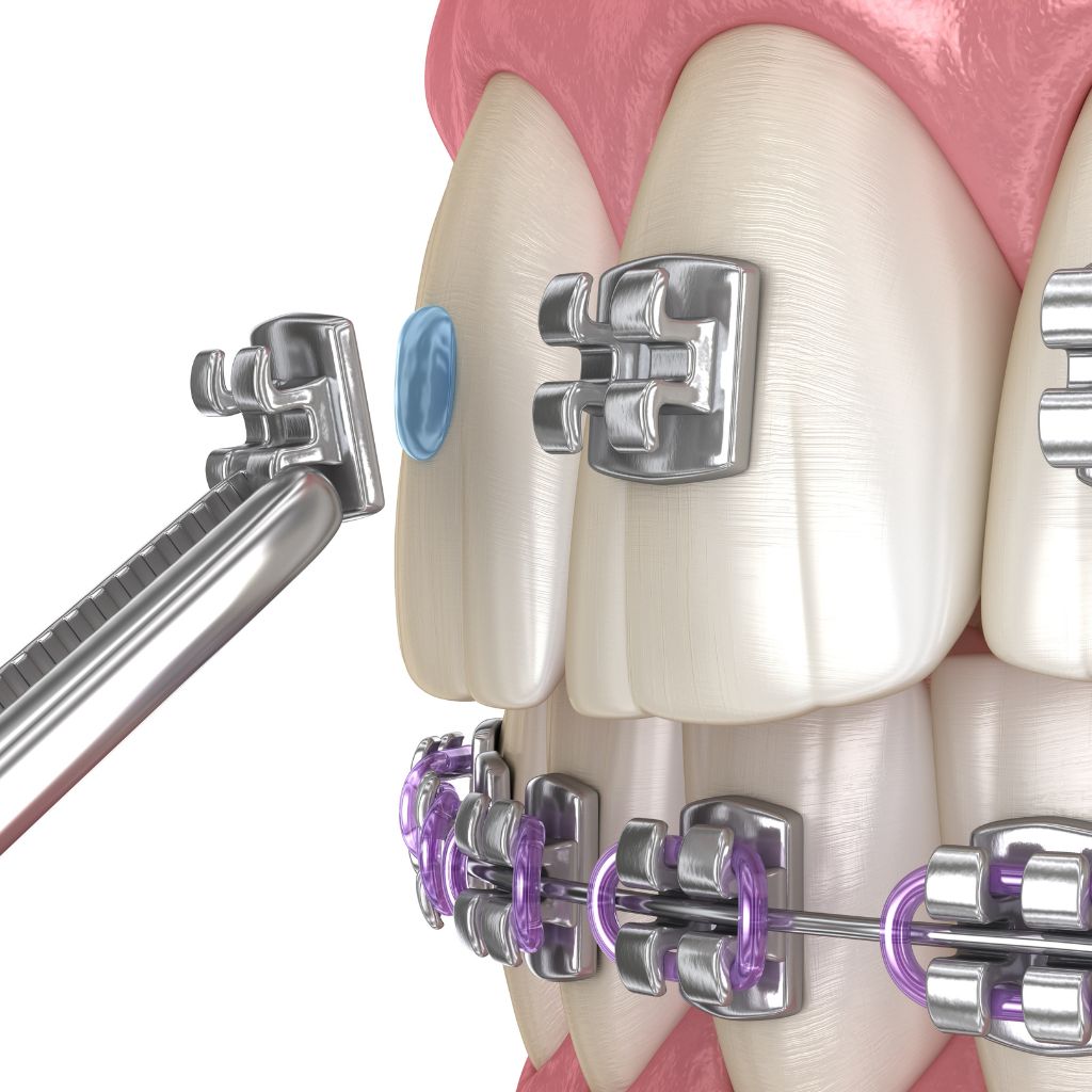 placing on braces