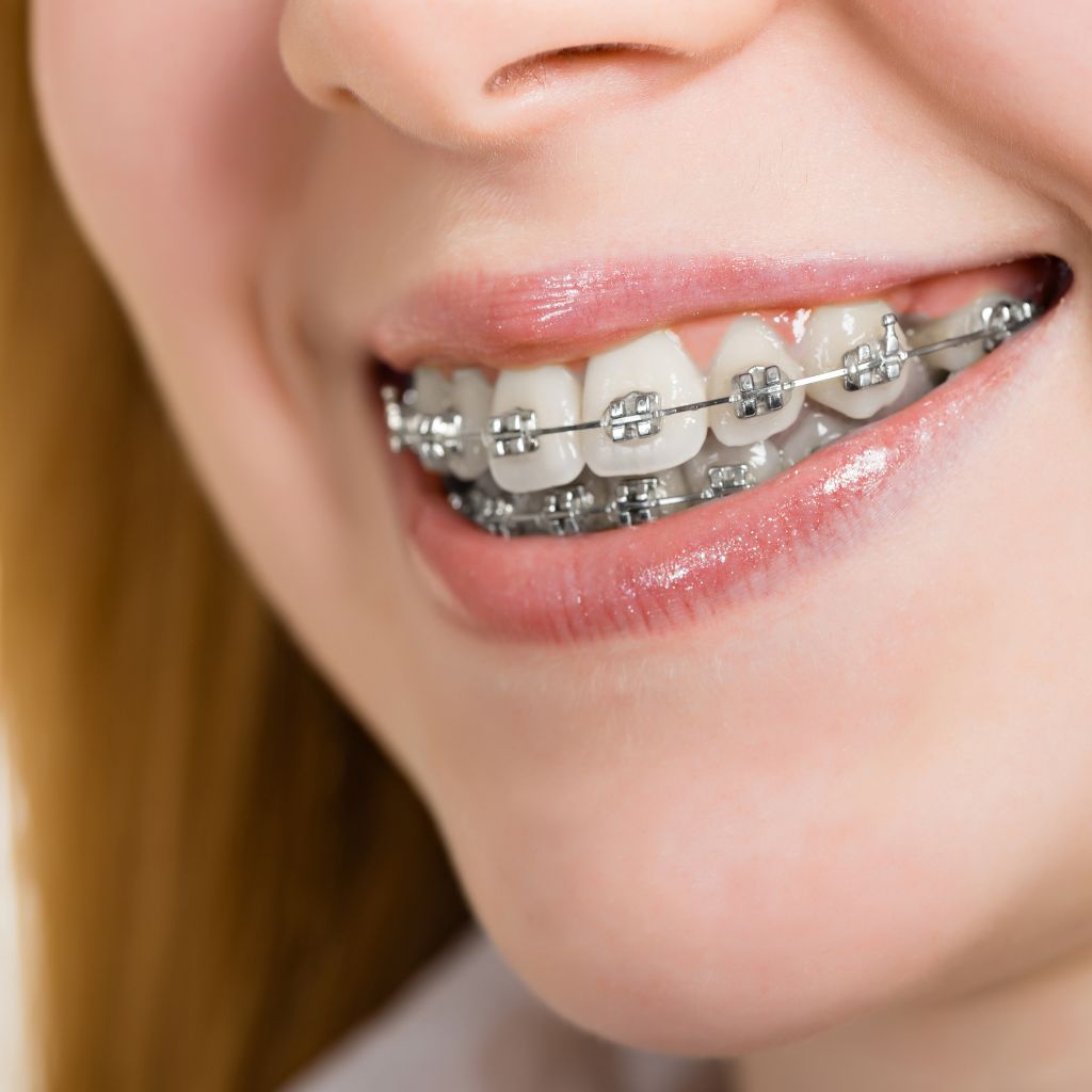 traditional metal braces