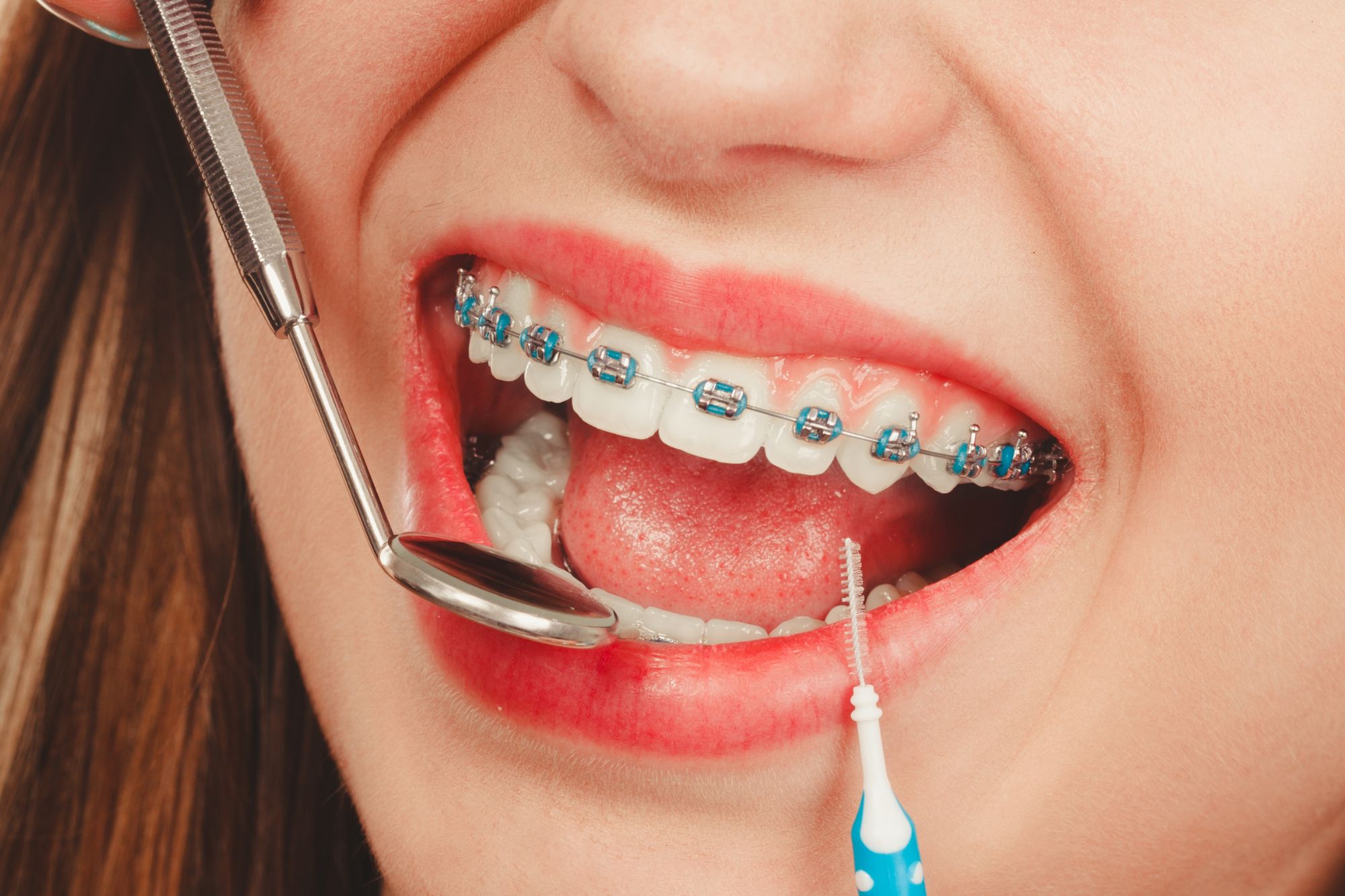 examining braces